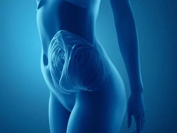Liposuction Cygnus